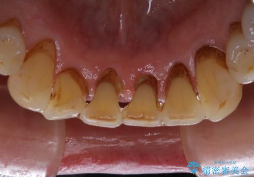 空気が漏れて喋りづらい:適合の良いセラミックで歯をつくるの治療前