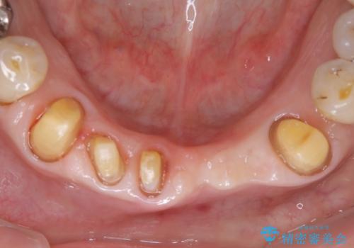 空気が漏れて喋りづらい:適合の良いセラミックで歯をつくるの治療中