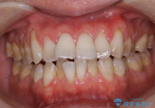 PMTCによる着色(ステイン)落とし