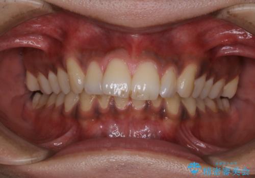 他人から口臭を指摘されて初めてのPMTCの治療前