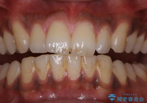 他人から口臭を指摘されて初めてのPMTCの治療前