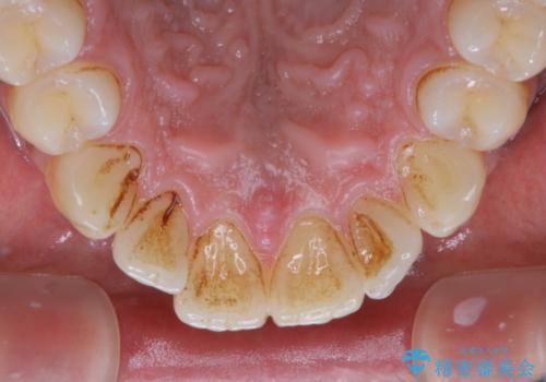 他人から口臭を指摘されて初めてのPMTCの治療前