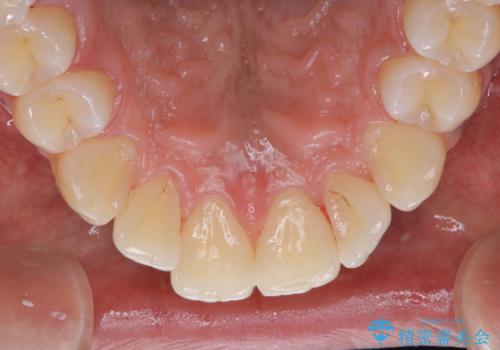 他人から口臭を指摘されて初めてのPMTCの治療後