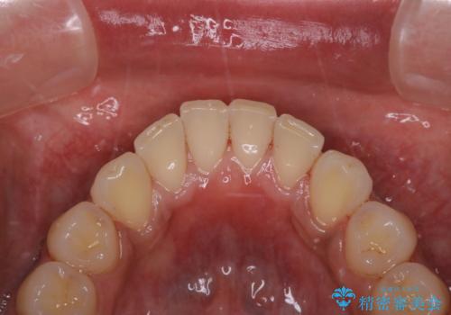他人から口臭を指摘されて初めてのPMTCの治療後