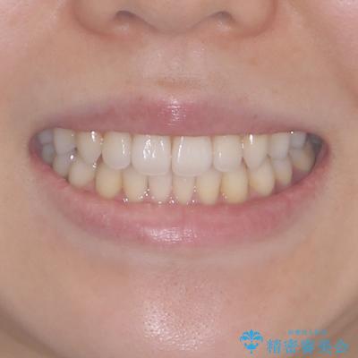 インビザラインで口を閉じやすくの治療後(顔貌)