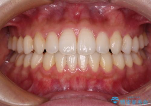 インビザラインで口を閉じやすくの症例 治療後