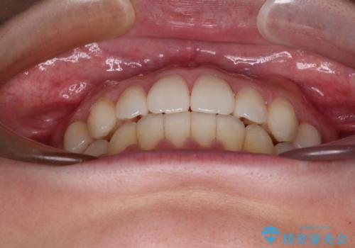 インビザラインで口を閉じやすくの治療後