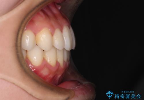 インビザラインで口を閉じやすくの治療後