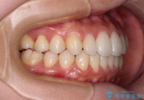 インビザラインで口を閉じやすくの治療後