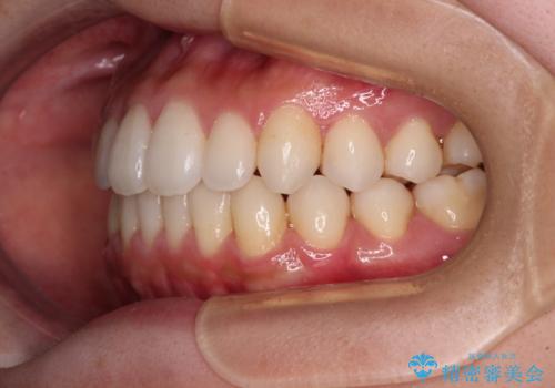 インビザラインで口を閉じやすくの治療後