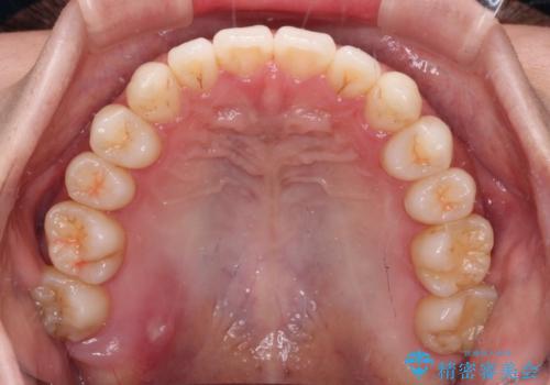 インビザラインで口を閉じやすくの治療後
