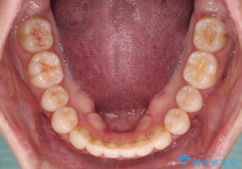インビザラインで口を閉じやすくの治療後