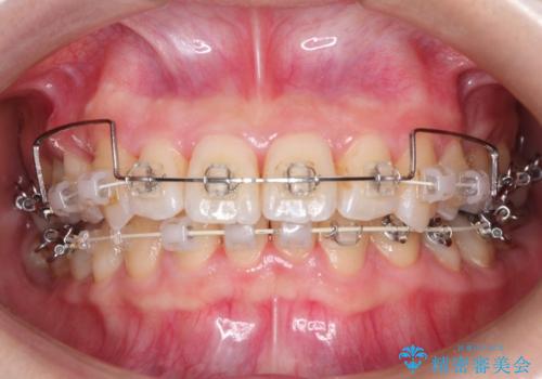 【がたつき・深い噛み合わせでお悩みの方必見】抜歯矯正症例(審美ワイヤー矯正)の治療中