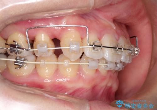 【がたつき・深い噛み合わせでお悩みの方必見】抜歯矯正症例(審美ワイヤー矯正)の治療中