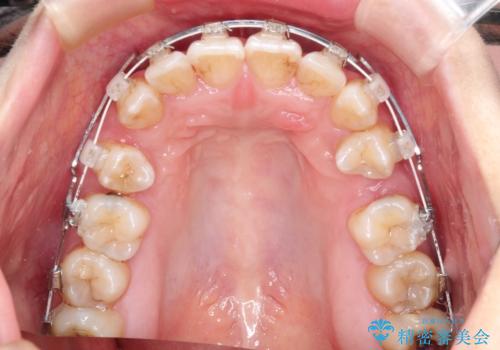 【がたつき・深い噛み合わせでお悩みの方必見】抜歯矯正症例(審美ワイヤー矯正)の治療中
