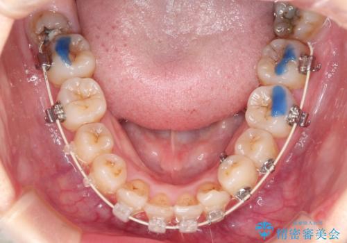 【がたつき・深い噛み合わせでお悩みの方必見】抜歯矯正症例(審美ワイヤー矯正)の治療中
