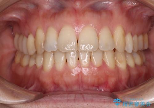 後戻りの再矯正治療と欠損部の補綴治療の症例 治療後