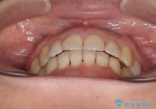 後戻りの再矯正治療と欠損部の補綴治療の治療後