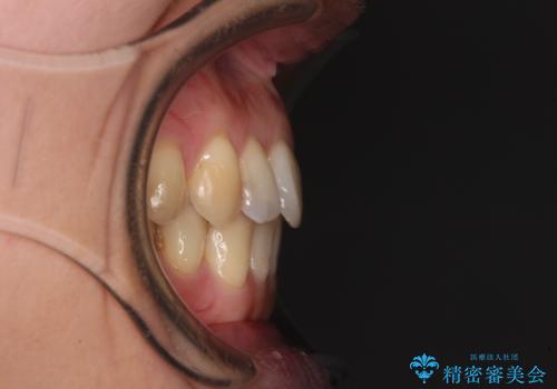 後戻りの再矯正治療と欠損部の補綴治療の治療後