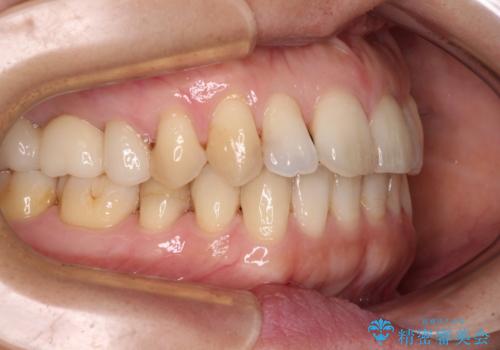 後戻りの再矯正治療と欠損部の補綴治療の治療後