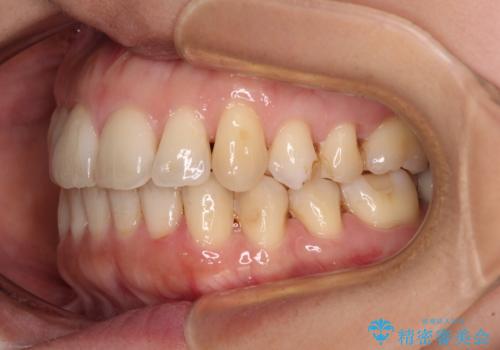 後戻りの再矯正治療と欠損部の補綴治療の治療後