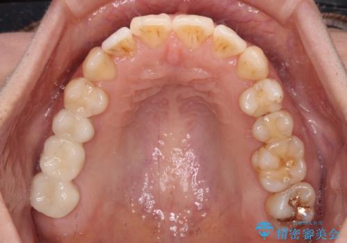 後戻りの再矯正治療と欠損部の補綴治療の治療後