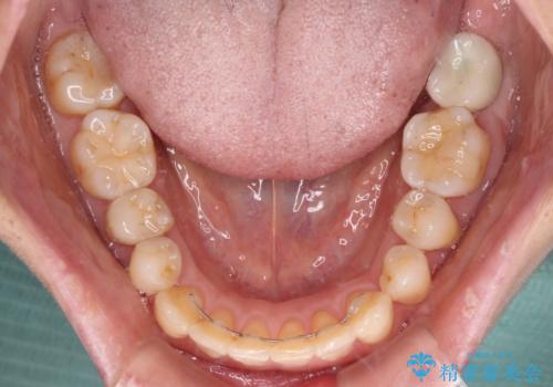後戻りの再矯正治療と欠損部の補綴治療の治療後