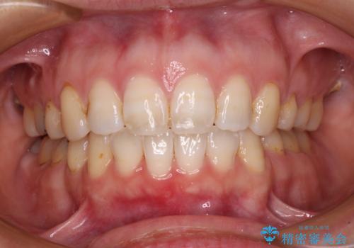 口元の突出感改善　なるべく銀歯を抜歯してワイヤー矯正の症例 治療後