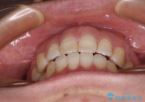 口元の突出感改善 なるべく銀歯を抜歯してワイヤー矯正の治療後