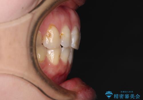 口元の突出感改善 なるべく銀歯を抜歯してワイヤー矯正の治療後