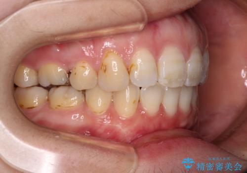 口元の突出感改善 なるべく銀歯を抜歯してワイヤー矯正の治療後