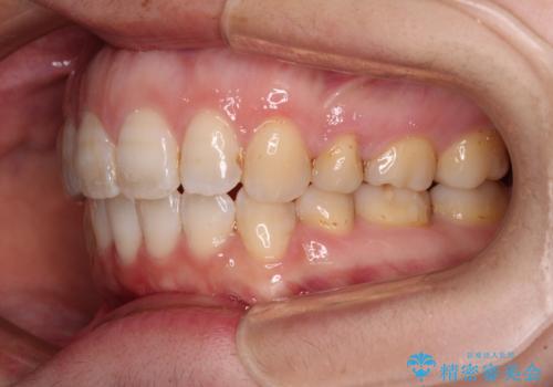 口元の突出感改善　なるべく銀歯を抜歯してワイヤー矯正の治療後