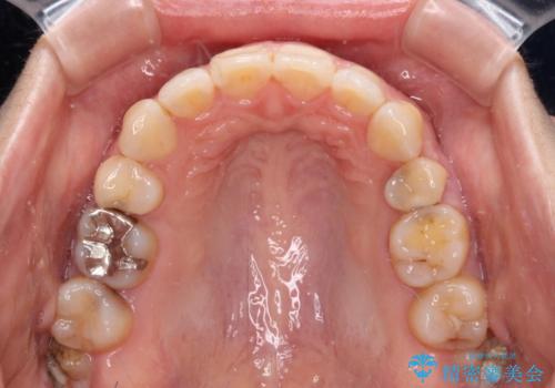 口元の突出感改善 なるべく銀歯を抜歯してワイヤー矯正の治療後