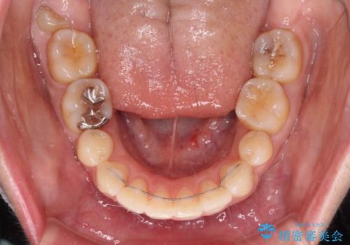 口元の突出感改善 なるべく銀歯を抜歯してワイヤー矯正の治療後
