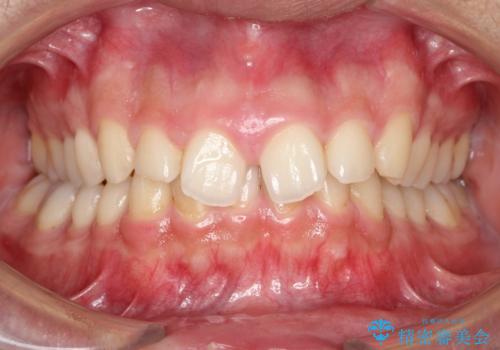 【過蓋咬合・正中離開・奥歯のズレでお悩みの方必見】非抜歯矯正症例(顎骨の成長を利用)の症例 治療前