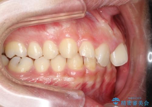 【過蓋咬合・正中離開・奥歯のズレでお悩みの方必見】非抜歯矯正症例(顎骨の成長を利用)の治療前