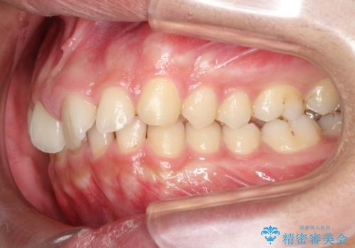 【過蓋咬合・正中離開・奥歯のズレでお悩みの方必見】非抜歯矯正症例(顎骨の成長を利用)の治療前