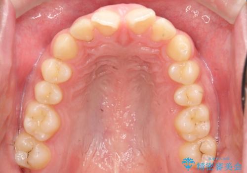 【過蓋咬合・正中離開・奥歯のズレでお悩みの方必見】非抜歯矯正症例(顎骨の成長を利用)の治療前