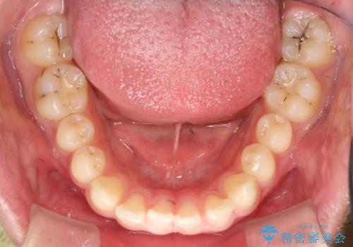 【過蓋咬合・正中離開・奥歯のズレでお悩みの方必見】非抜歯矯正症例(顎骨の成長を利用)の治療前