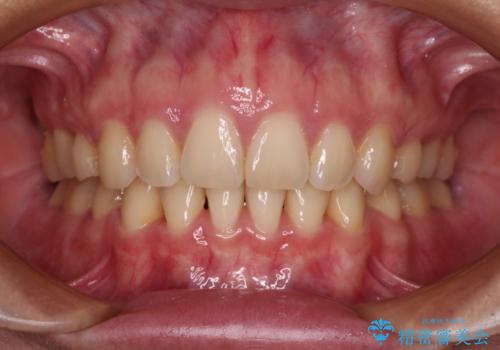 上顎前突 目立たないワイヤー装置での抜歯矯正の症例 治療後