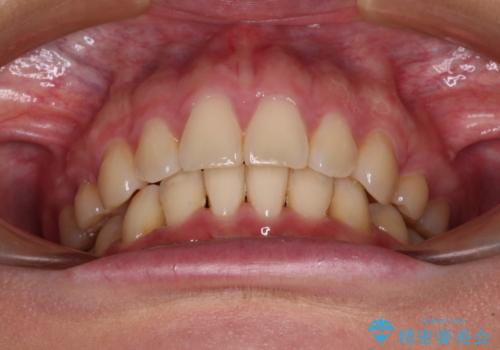 上顎前突 目立たないワイヤー装置での抜歯矯正の治療後