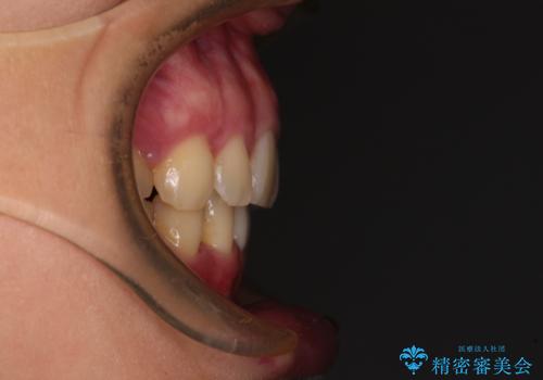 上顎前突 目立たないワイヤー装置での抜歯矯正の治療後