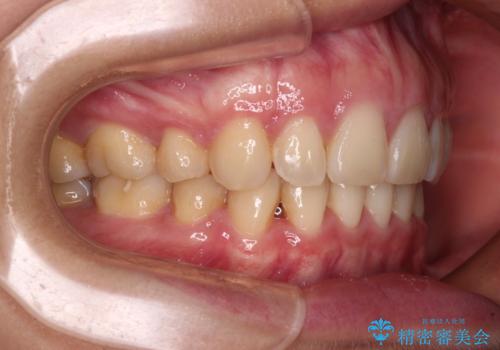 上顎前突 目立たないワイヤー装置での抜歯矯正の治療後