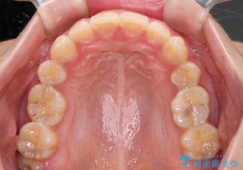 上顎前突 目立たないワイヤー装置での抜歯矯正の治療後