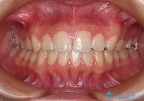 カリエール・ディスタライザーとインビザラインを用いた奥歯の咬み合わせ改善