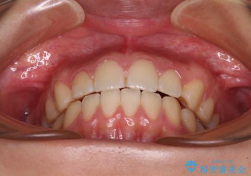 カリエール・ディスタライザーとインビザラインを用いた奥歯の咬み合わせ改善の治療後