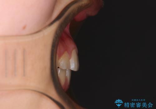 カリエール・ディスタライザーとインビザラインを用いた奥歯の咬み合わせ改善の治療後