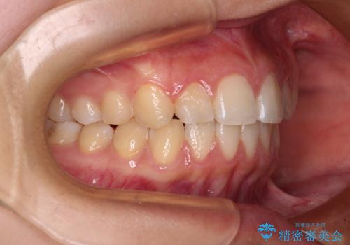 カリエール・ディスタライザーとインビザラインを用いた奥歯の咬み合わせ改善の治療後