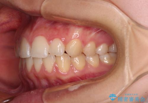 カリエール・ディスタライザーとインビザラインを用いた奥歯の咬み合わせ改善の治療後