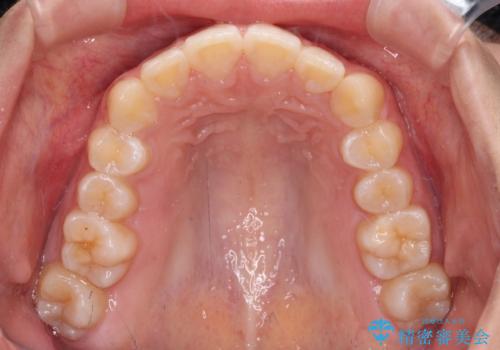 カリエール・ディスタライザーとインビザラインを用いた奥歯の咬み合わせ改善の治療後